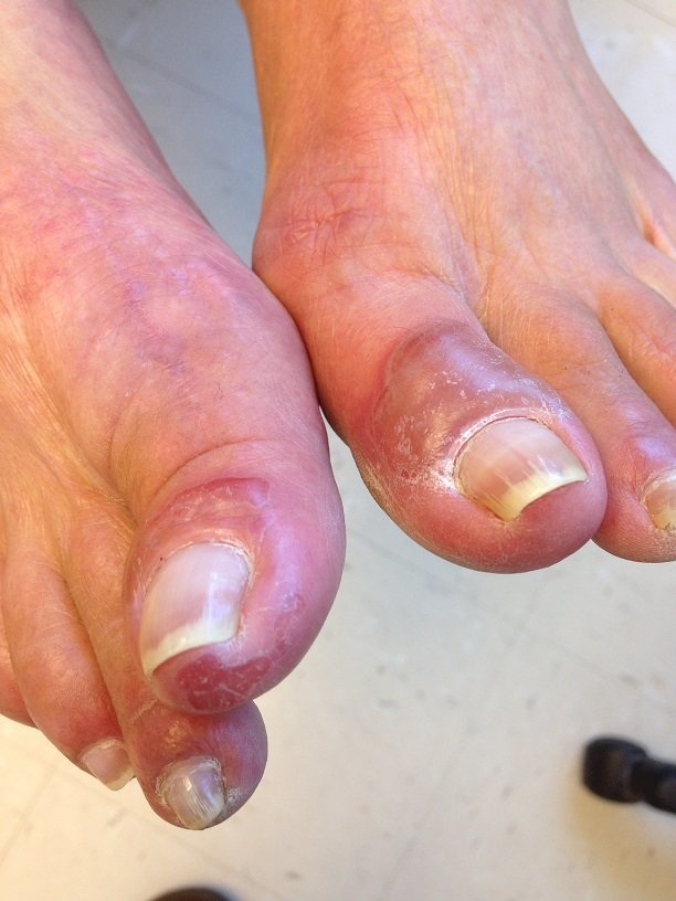 Pemphigus vulgaris of the foot